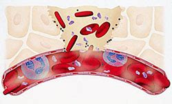 Widening of a blood vessel can rupture .